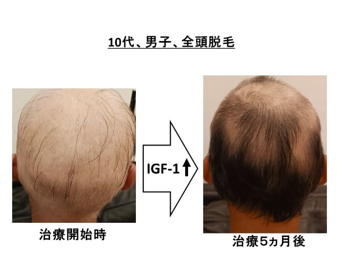 円形脱毛症　病院
